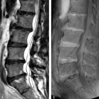 MRI of the lumbar spine of a subject with no chronic low back pain. (Left) T2-weighted MRI noting multilevel disc degeneration and Modic changes. (Right) Ultra-short time-to-echo (UTE) MRI noting no UTE disc sign (UDS).